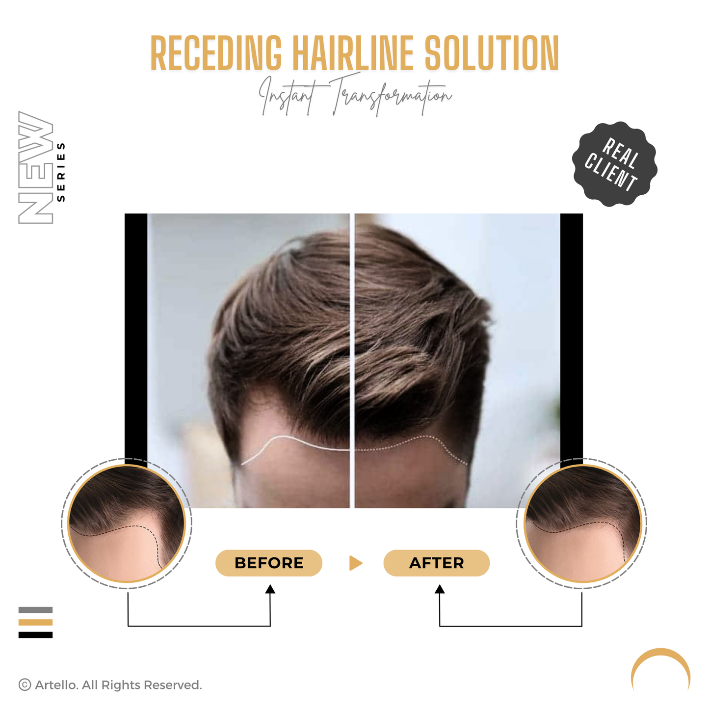 Artello POLY FRONTAL Cover Up Hair Patch for Men and Women for Receding Hairline
