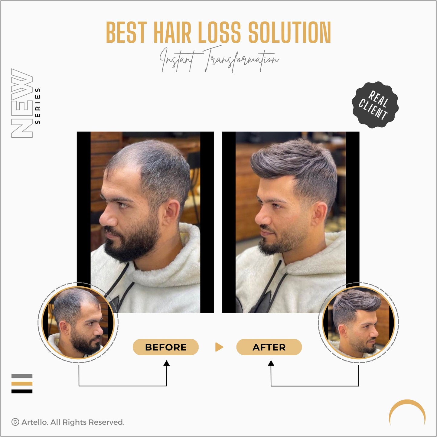 Artello® FRONT LACE Smart Hair Patch for Men - ArtelloHair Patch